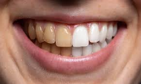 The Different Types of Teeth Stains and How to Remove Them