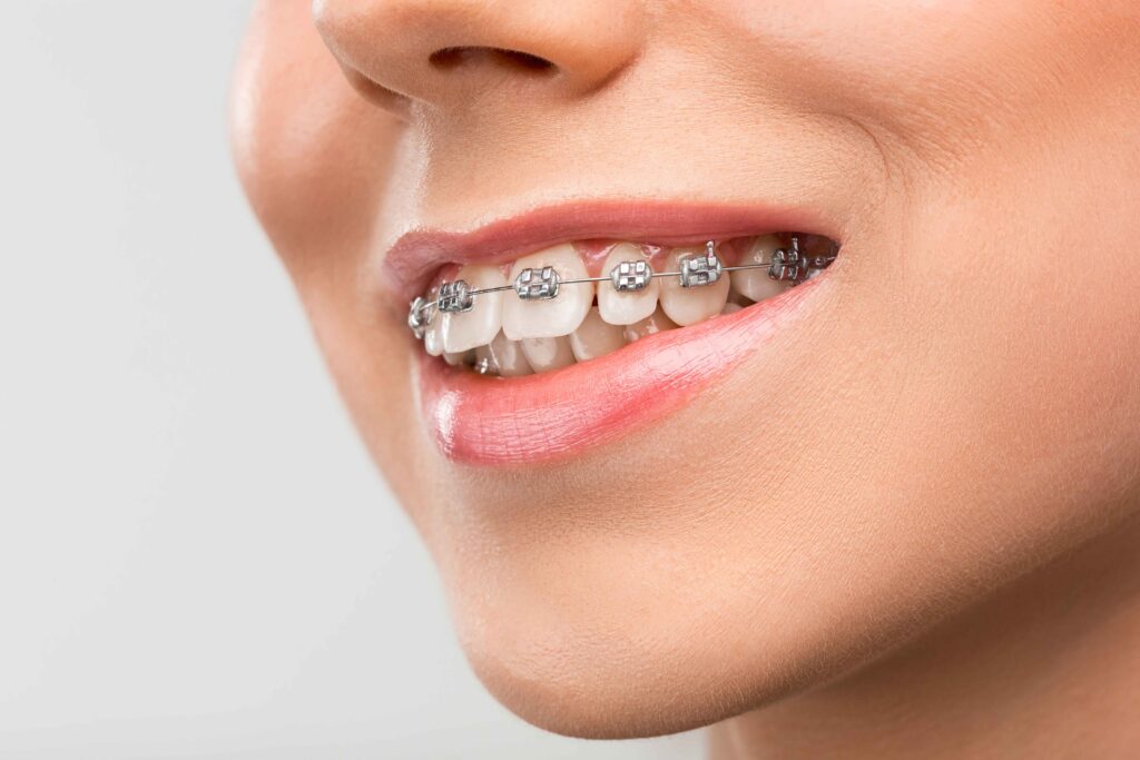 beautiful-young-woman-with-teeth-braces